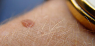 rti neurali: peli del braccio che si alzano